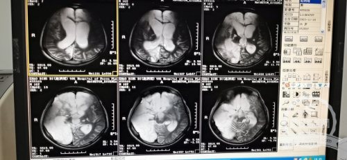 昏迷200余天植物人有望苏醒，西北首例VNS手术成功实施