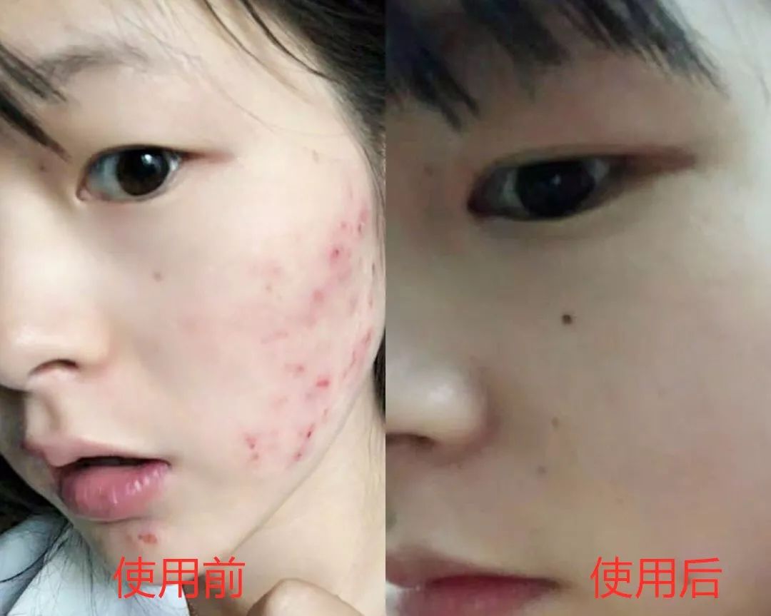 用什么洗脸抑制螨虫生长,用什么洗脸可以抑制螨虫生长