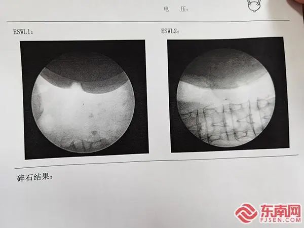 碎石神器!宁德市中医院引进国内新款大型双定位体外碎石机
