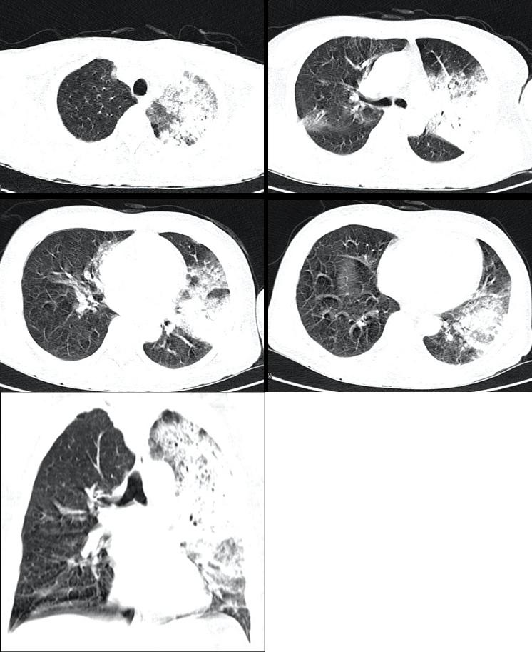 肺炎患者抢救记录,新冠肺炎危重症患者抢救成功案例