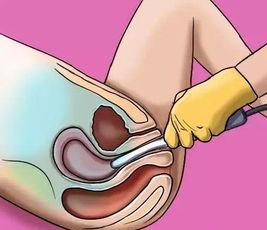 经直肠超声和经会阴超声的区别,腹部超声检查图像