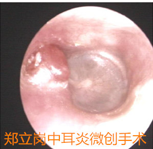 不明原因的听力下降是怎么回事,胆脂瘤中耳炎出血意味着什么呢