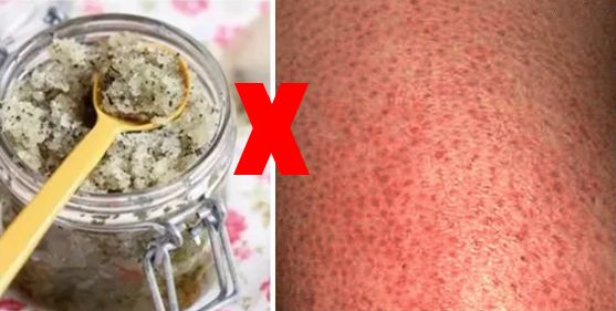 别放弃，烦人的“鸡皮疙瘩”，真的还可以再救一下