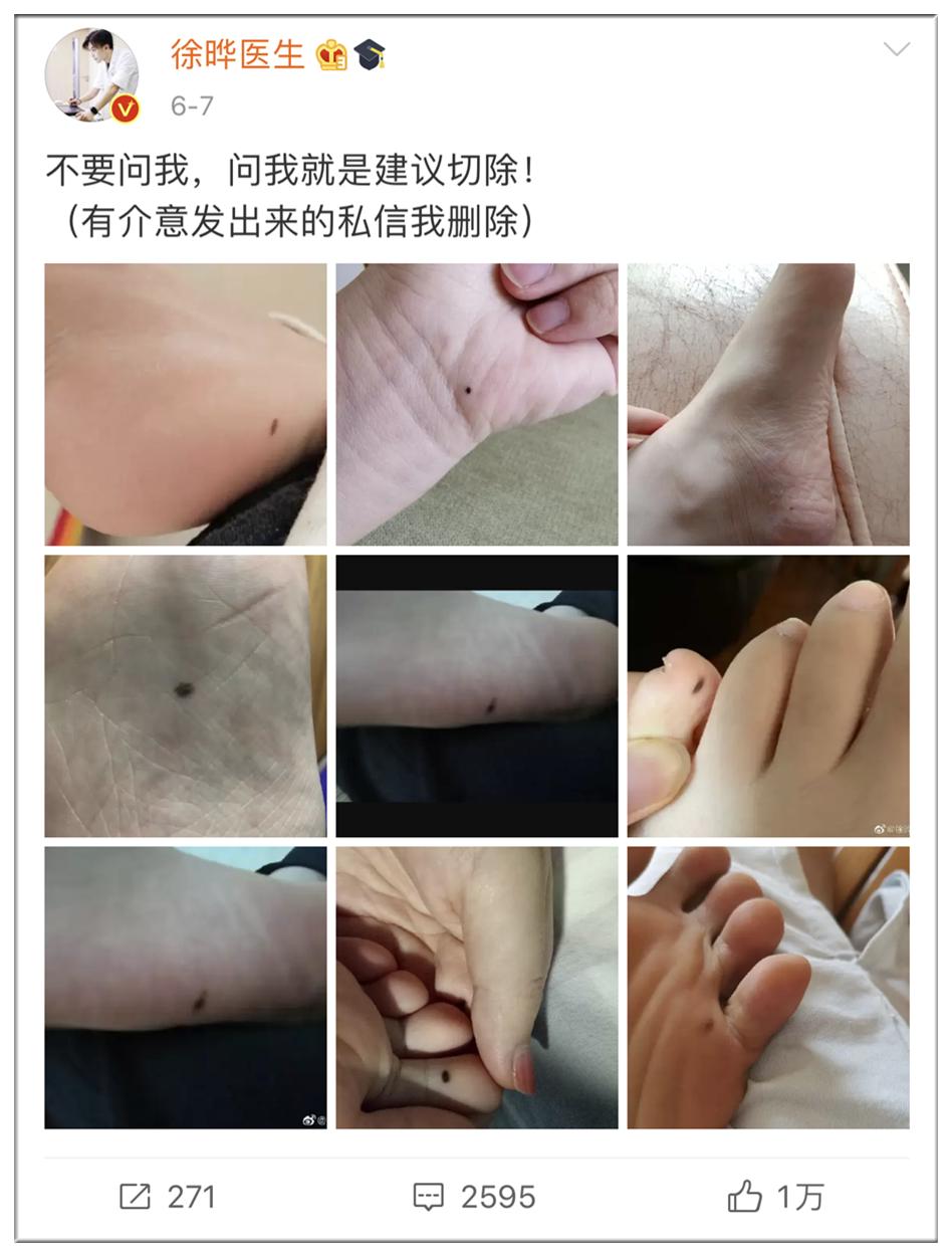 注意|这几天上万网友在身上找痣！知名医生：长在这些地方的特别留意！
