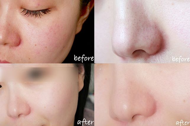 超微小气泡毛孔吸尘器使用方法,毛孔吸尘器去黑头收缩毛孔