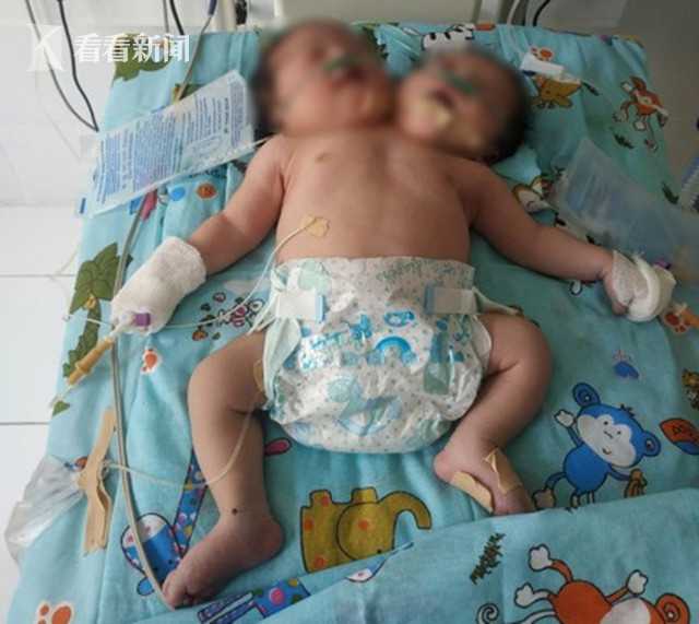 孕妇不听劝告生下连体婴儿,妻子怀孕查出是连体婴