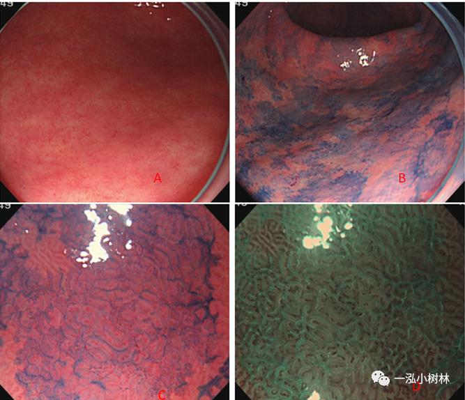 肠上皮化生做什么检查,肠化生内镜看得出来吗