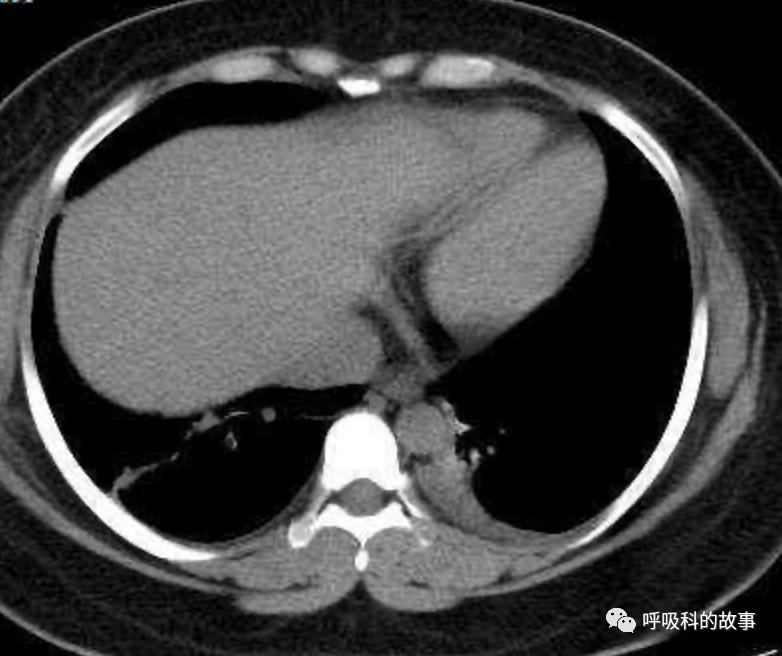 五花八门的发热之一—药物热（1）