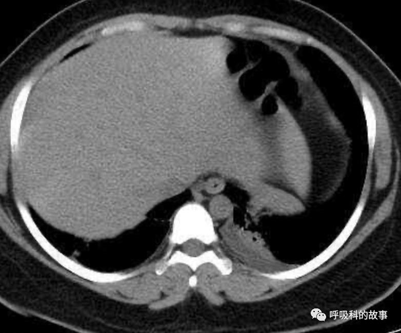 五花八门的发热之一—药物热(1)