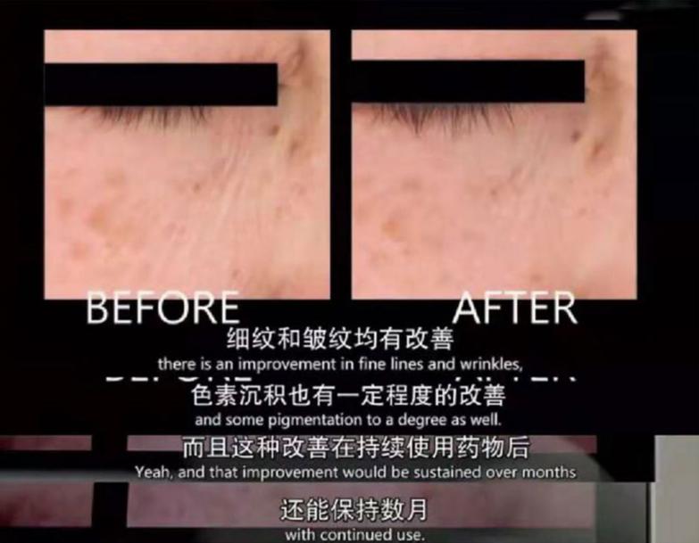 女人脖子有颈纹和年龄有关吗,一条颈纹代表二十岁