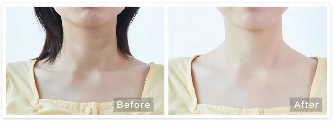 一条颈纹老十岁教你一招淡化,女人脖子有颈纹和年龄有关吗