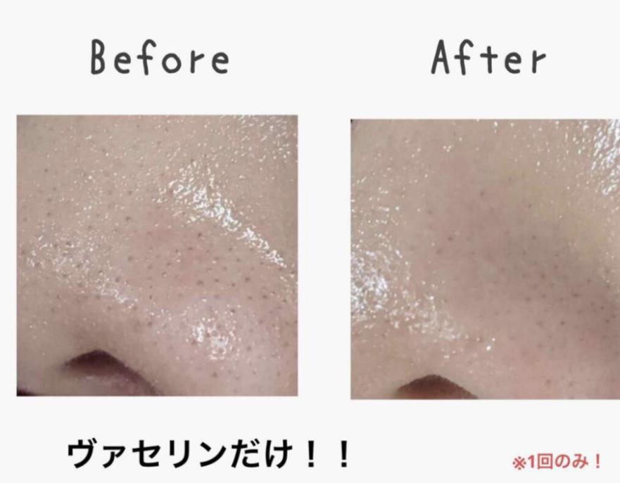 日网疯传超强去黑头「毛孔虐待」组合！3星期去除黑头，超12万点赞获官方认可