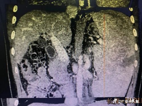 微创腹腔手术切除罕见巨脾,微创腹腔镜摘脾手术