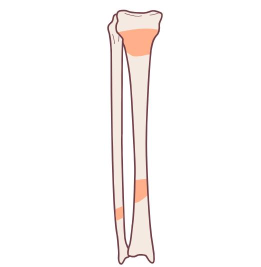 下肢神经损伤的十大症状,下肢损伤图片