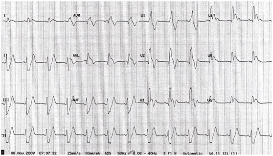 年轻人心源性晕厥发生的原因,心律失常突发性晕厥