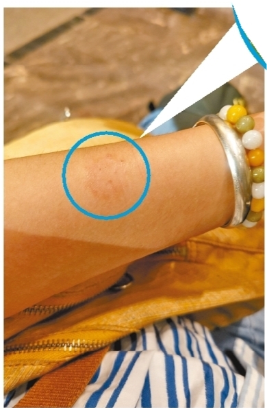 猫癣会传染人吗如果传染怎么处理,猫癣如何预防传染给人