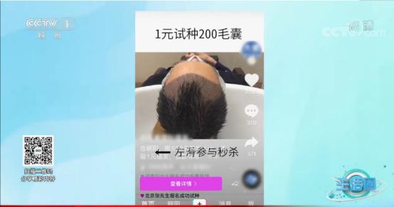 长期脱发去植发靠谱吗,脱发去植发真的靠谱吗