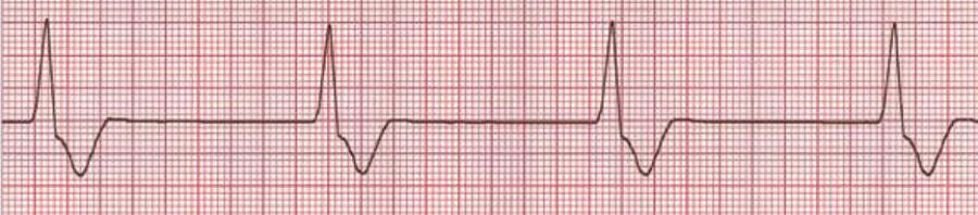 室速属于重大疾病吗,室速的相关资料