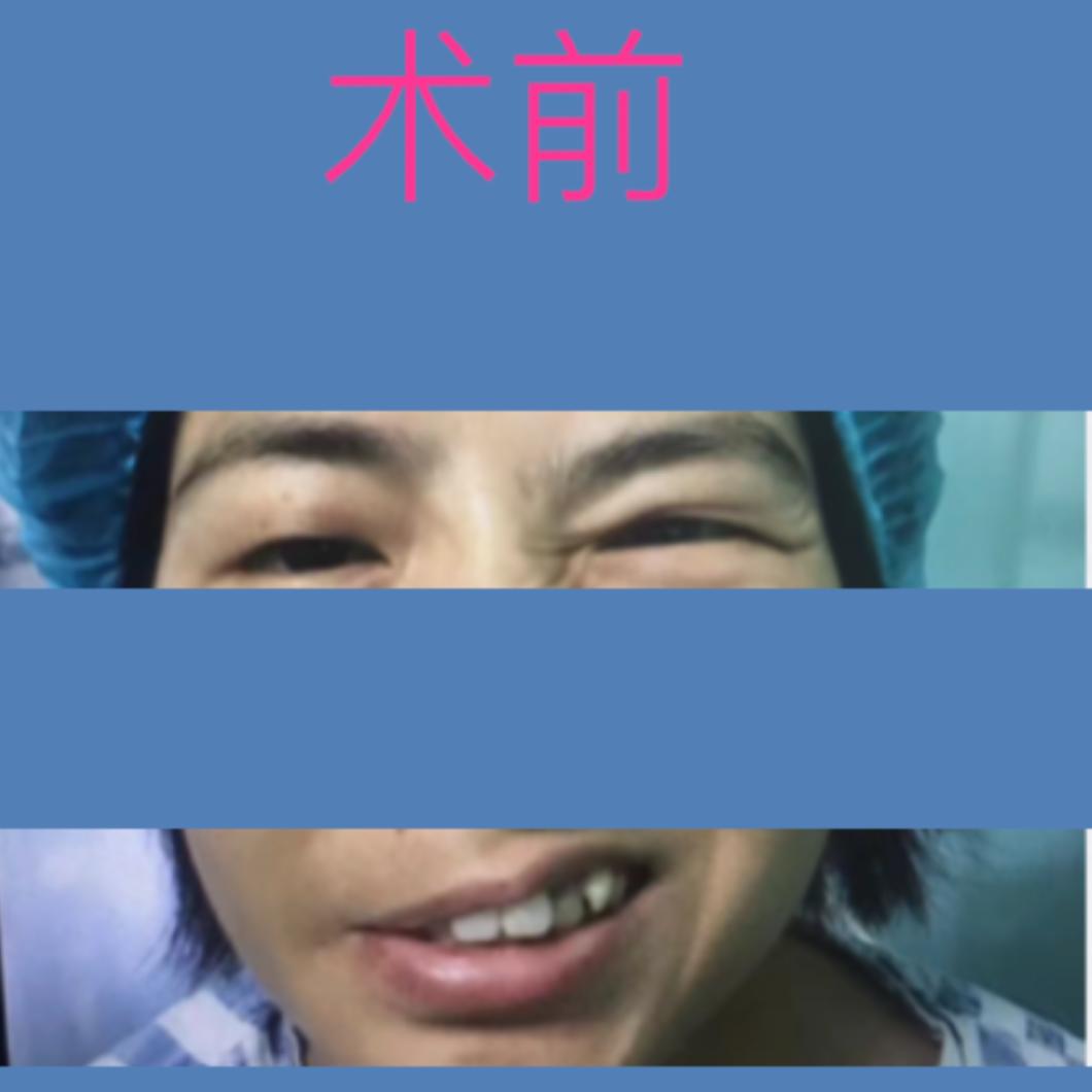 四川华西医院治疗面瘫怎么样,面瘫其实很难治愈