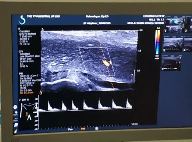 【世界男性健康日】那儿硬不起来?CDFI超声检查助你一探究竟……