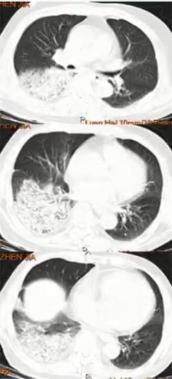 支原体肺炎症状中医诊治,成人肺炎支原体肺炎诊治专家共识