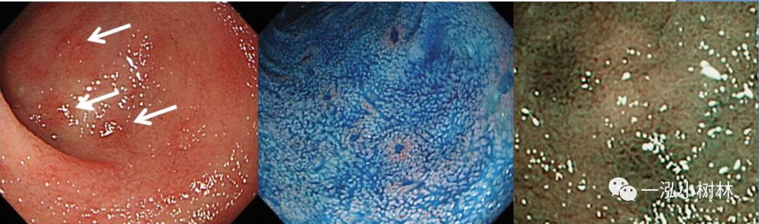 炎症性肠病内镜下表现,炎症性肠病早期筛查结果