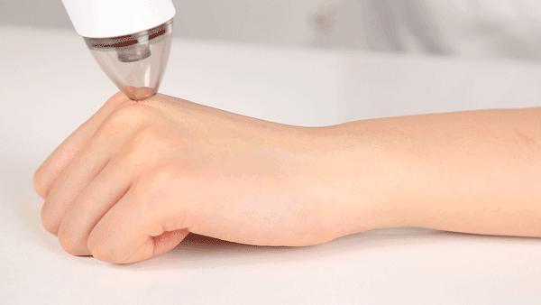 痘痘闭口挤出来的是什么,闭口痘痘挤出来白色物质