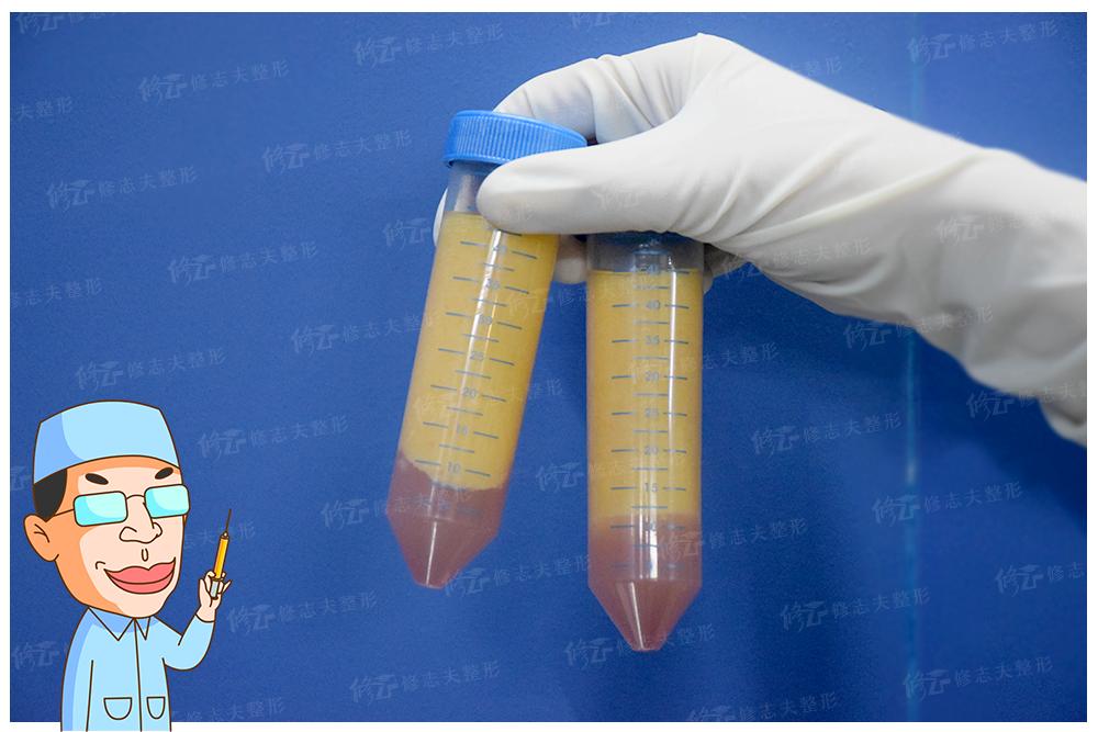 抽出来的脂肪为什么是液体,抽出来的脂肪去哪里了