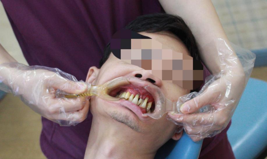 32岁男子几乎牙齿掉光,20岁小伙牙齿掉光