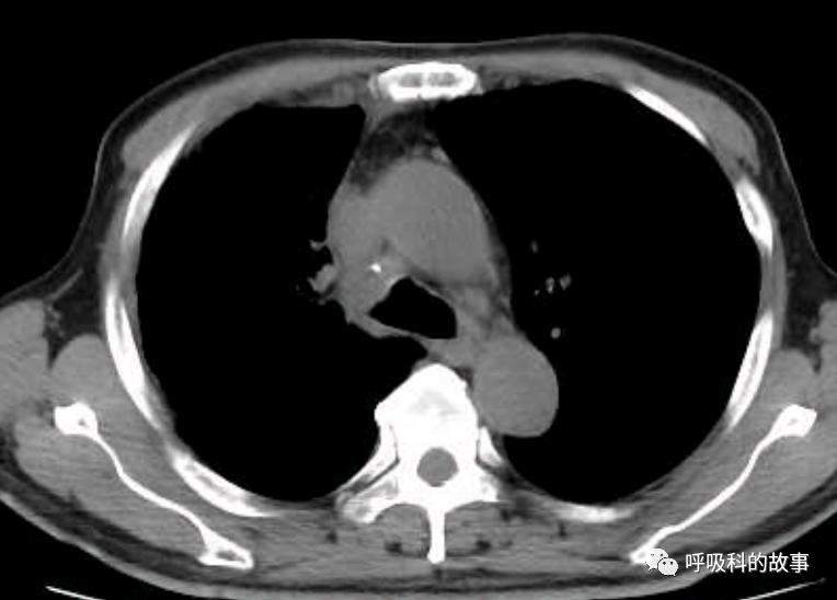 我是如何诊治肺炎的？（4）——如何理解抓住关键信息（2）