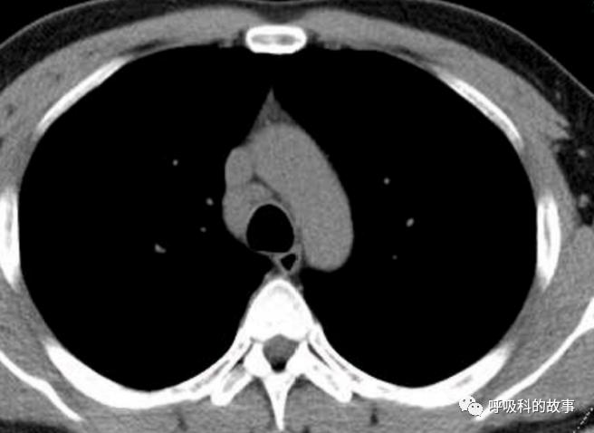 我是如何诊治肺炎的？（4）——如何理解抓住关键信息（2）