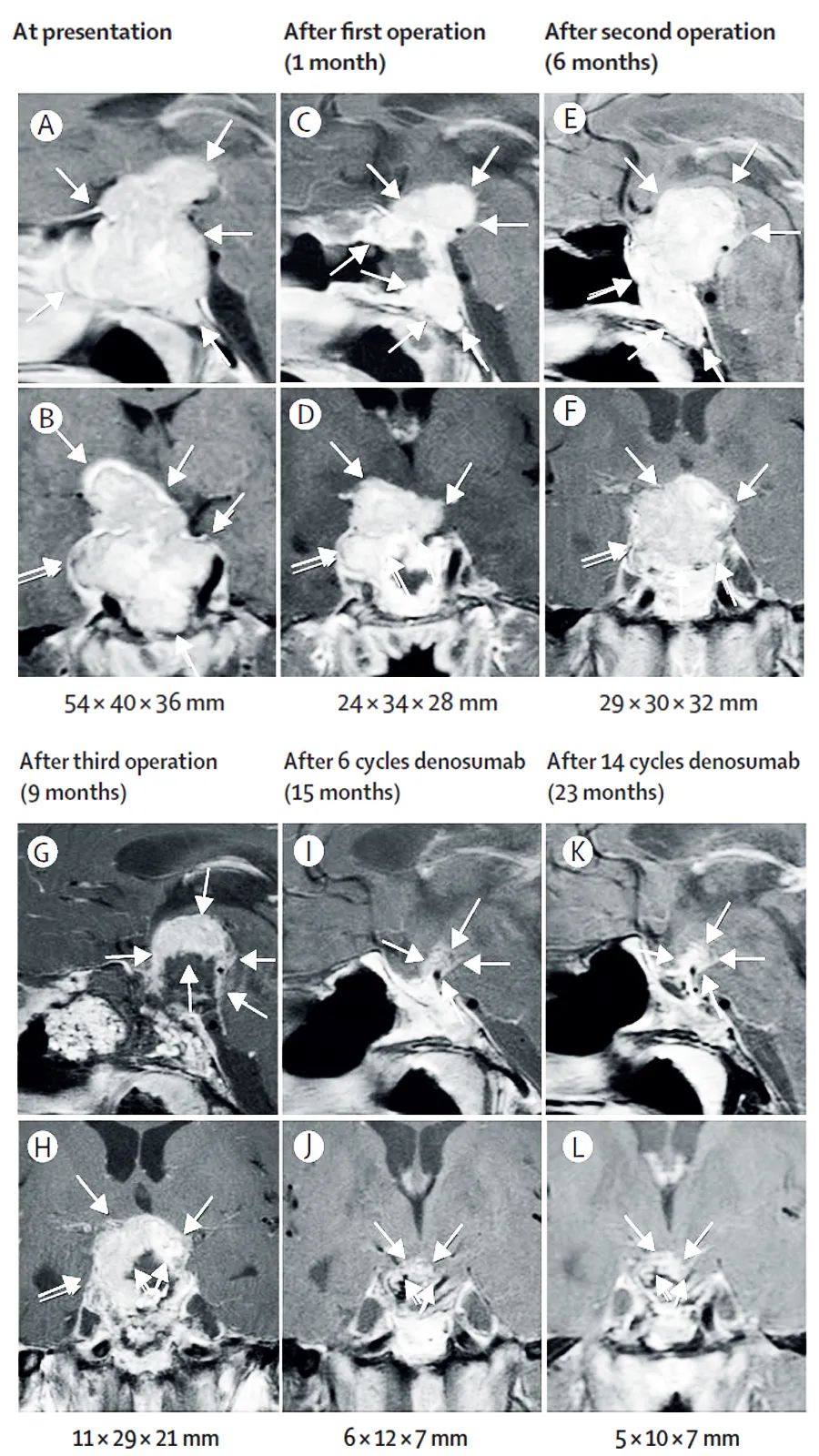 恶性骨巨细胞瘤靶向药,骨巨细胞瘤单抗治疗