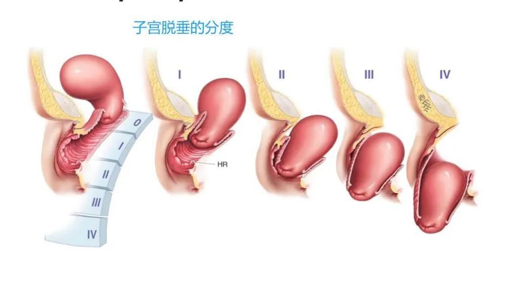 老年人子宫脱垂手术费用多少,子宫脱垂老年人手术危险吗