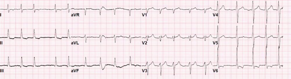 流感病毒会引起心脏问题吗,病毒引起的心脏罕见病