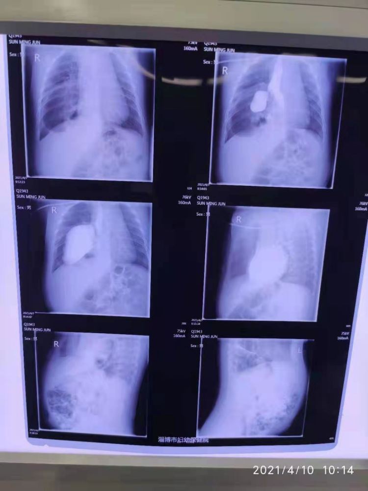 腹腔脏器修补术有哪些,腹腔镜空腔脏器修补术