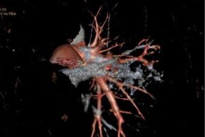 肺动静脉畸形介入手术成功率,肺动静脉畸形介入手术全过程