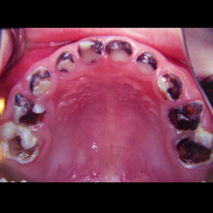 健康小站,3岁儿童有蛀牙不正常