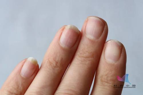 脚指甲盖发黄变厚有竖纹怎么回事,涨知识现象