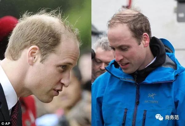 威廉王子秃顶了哈里为啥没秃顶,威廉王子为什么喜欢秃顶