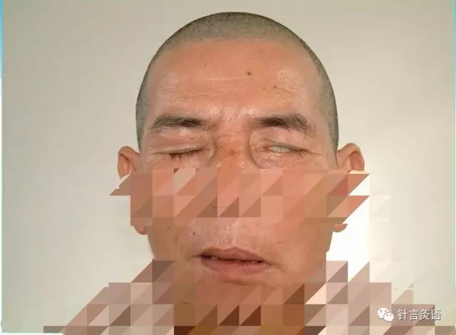 鍛ㄥ洿鎬ч潰鐦殑閽堢伕娌荤枟,鍛ㄥ洿鎬ч潰鐦殑閽堢伕鍘熷垯