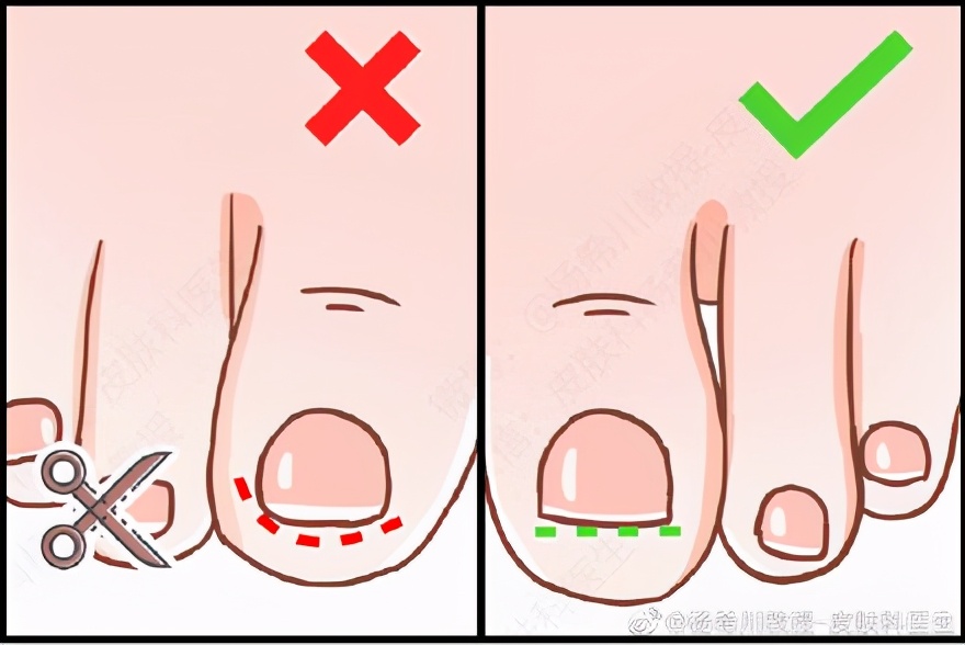 指甲剪得太短得甲沟炎,指甲剪的太短引起的甲沟炎