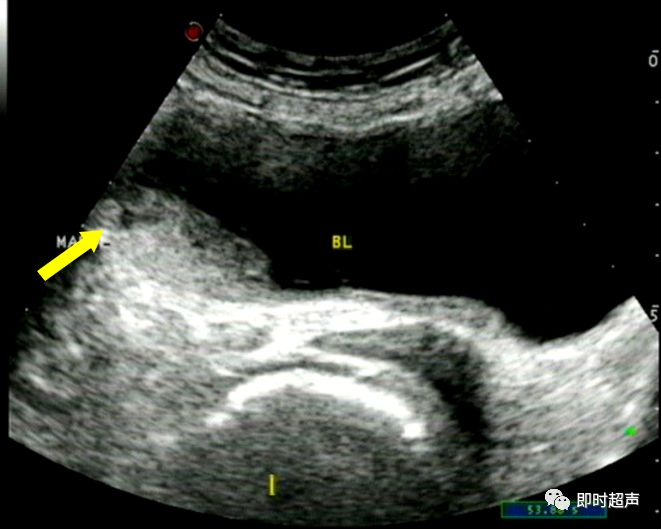 膀胱超声图解大全,膀胱超声解剖及常见病变超声表现