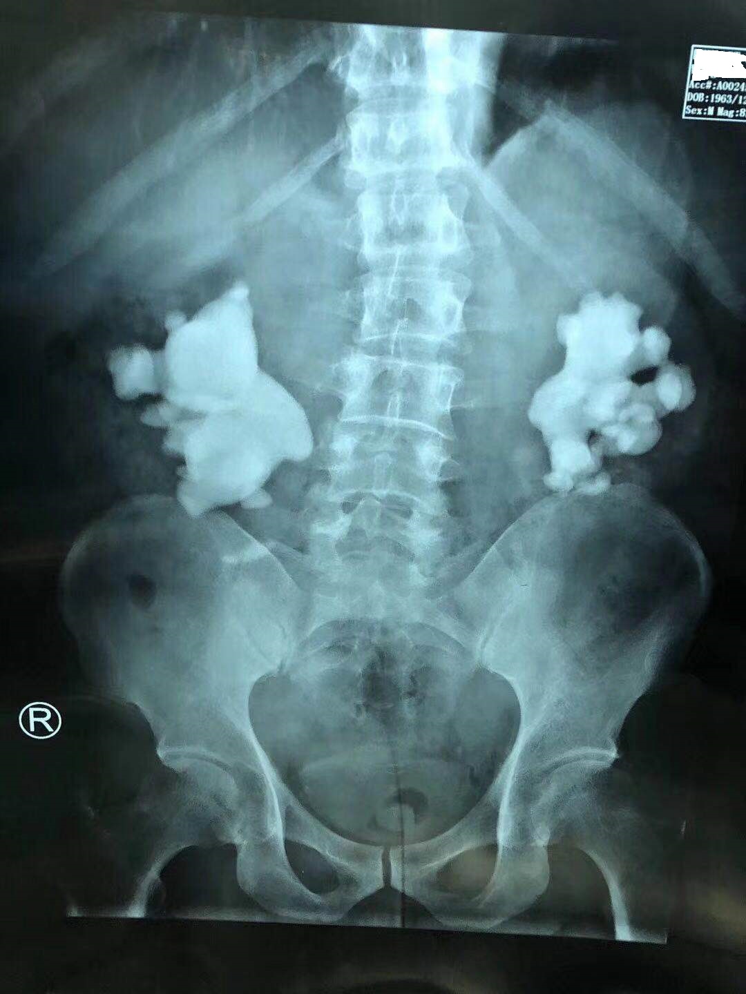 疯狂的石头除藻,肾结石鹿角形状的结石什么样