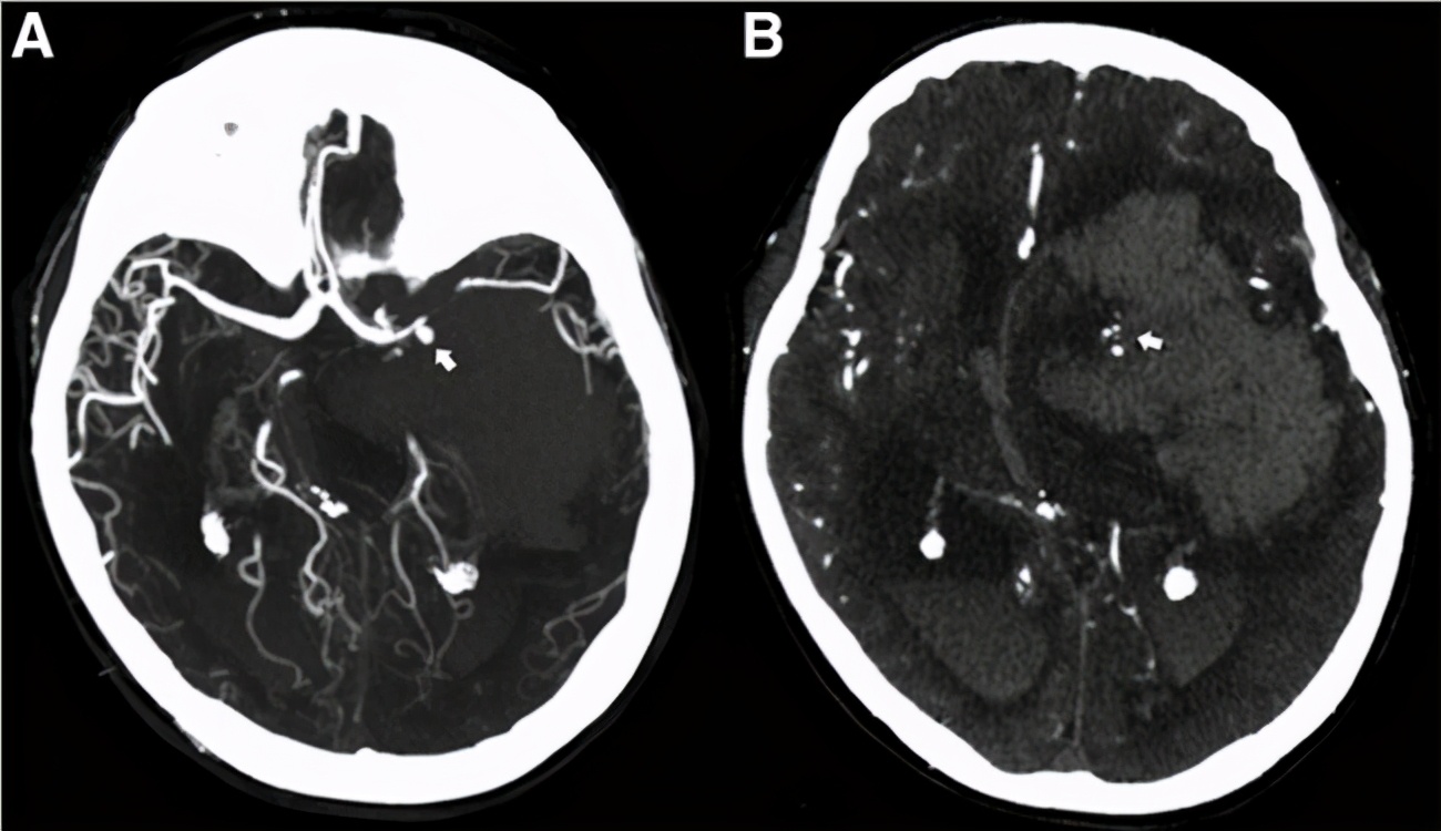 原发腹膜癌治疗方案,腹膜后肿瘤最佳治疗