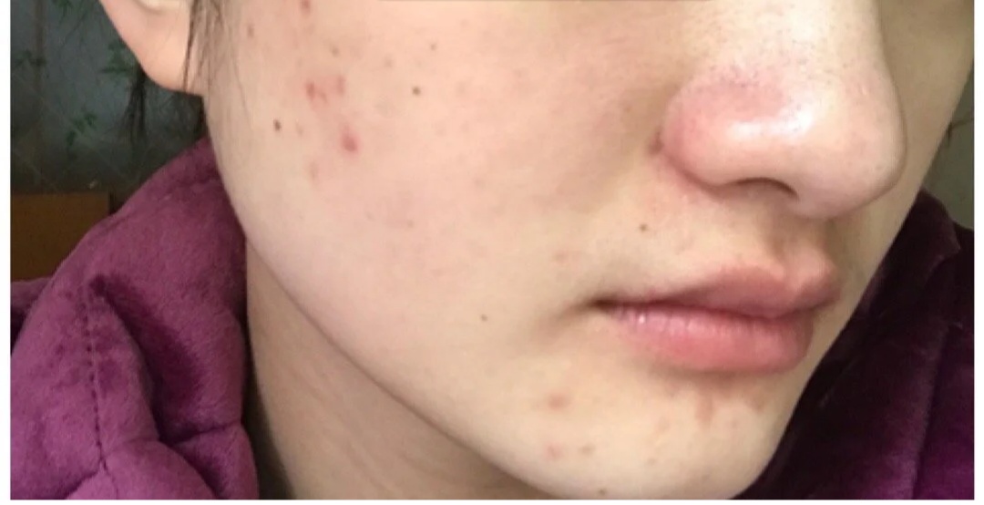 怎么有效简单的祛除痘印的方法,简单有效7大窍门祛除痘印