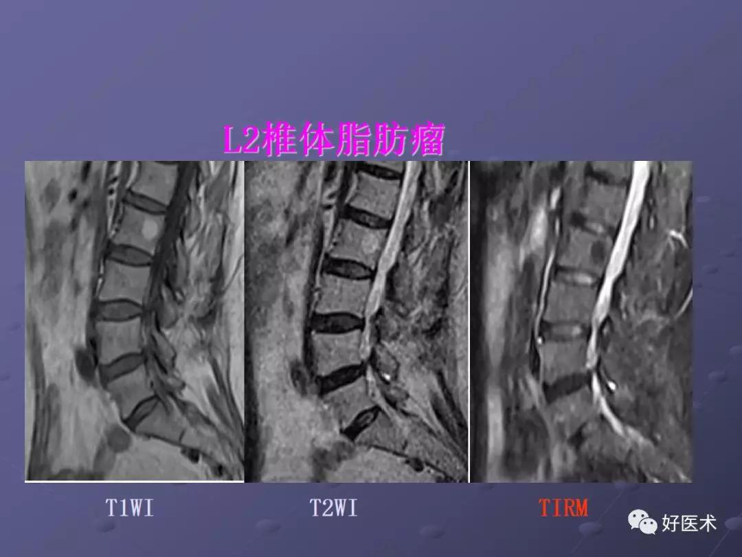 脊柱mri有哪些特点,乳腺疾病的mri诊断及鉴别