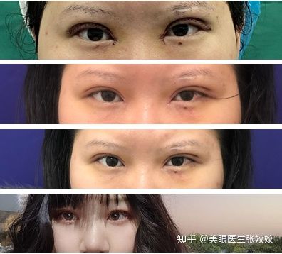 胖妹妹适合割双眼皮吗,胖女孩割双眼皮