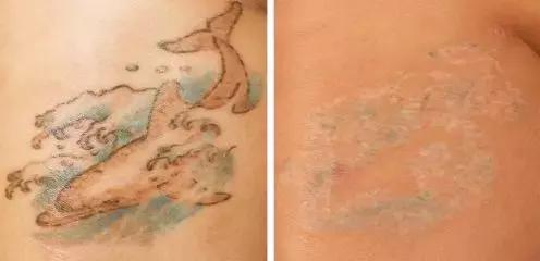 纹身的激光治疗,激光能祛纹身吗