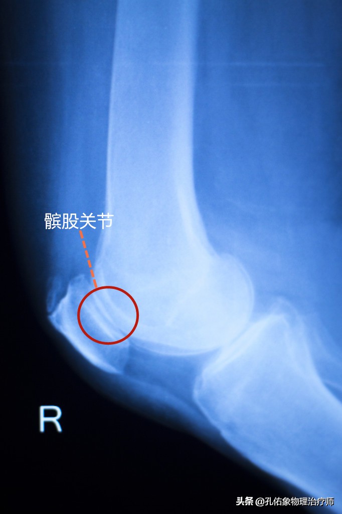 膝盖上下楼梯痛的治疗方法,直腿抬高膝关节弹响疼痛怎么治疗