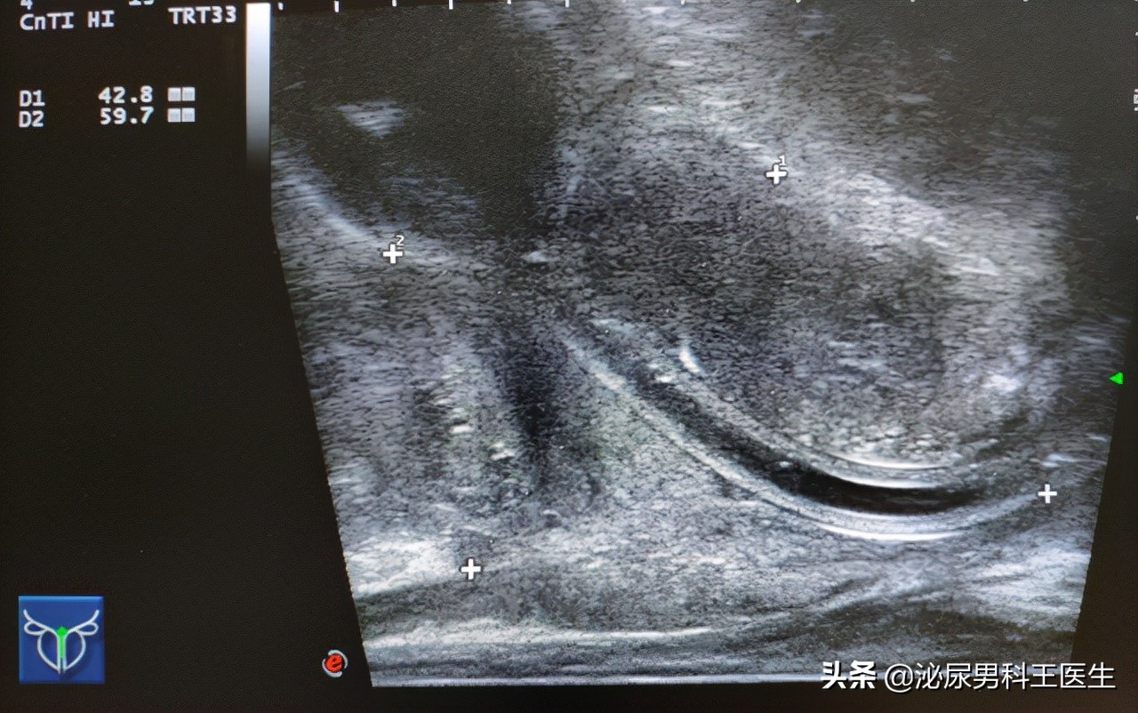 25岁前列腺增生是什么原因引起的,前列腺增生多久做一次psa检查好